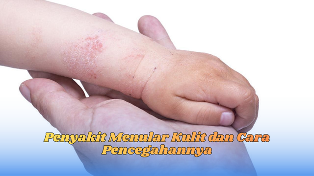 penyakit menular kulit